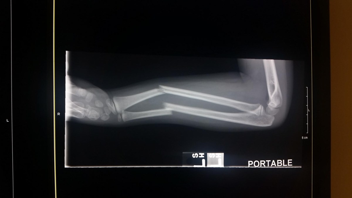 BrokenArm-10